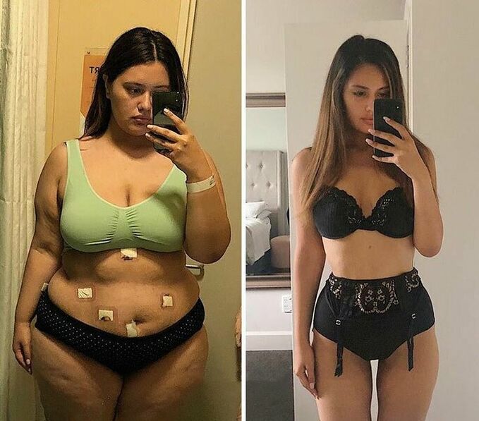 Κορίτσια πριν και μετά την απώλεια βάρους με κάψουλες KETO Complete